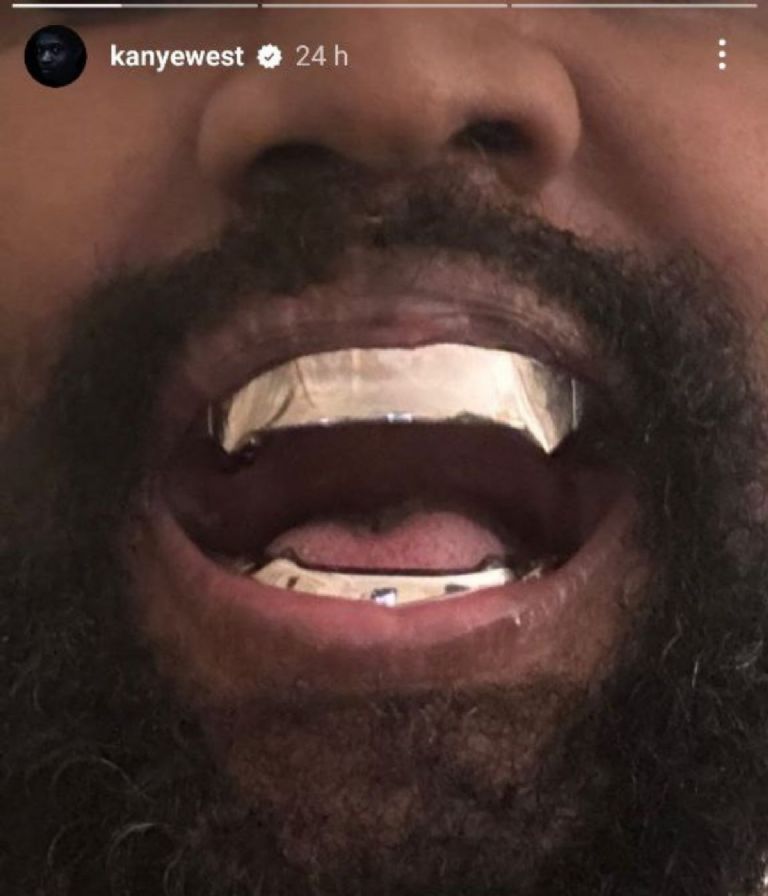 Kanye West dentadura de titanio